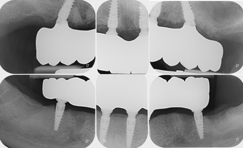immagine protesi definitive
