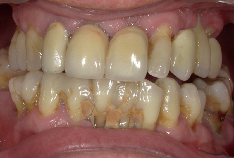 vecchia riabilitazione con protesi fissa superiore