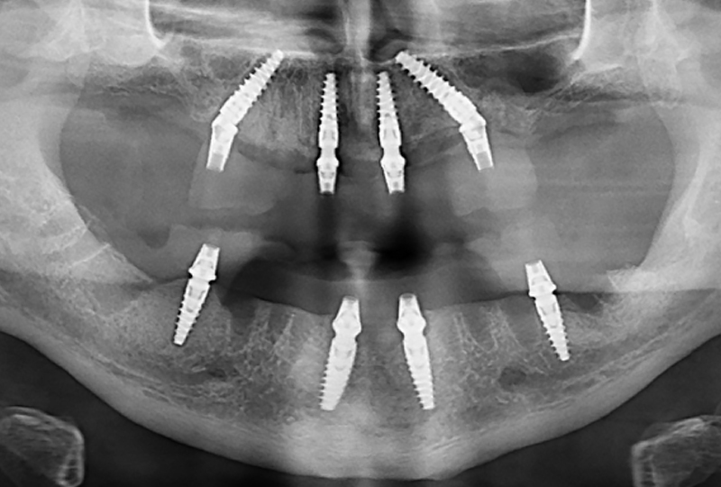 chirurgia All-on-4 e posizionamento di due protesi fisse a carico immediato