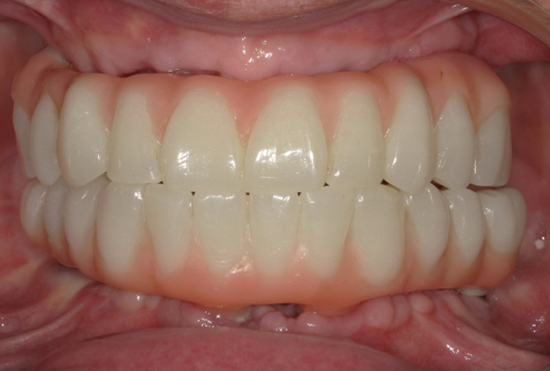 sessioni di chirurgia All-on-4 con posizionamento di due protesi fisse a carico immediato in PMMA