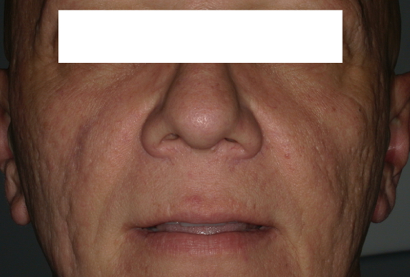 foto extra-orali a tre mesi dal secondo intervento