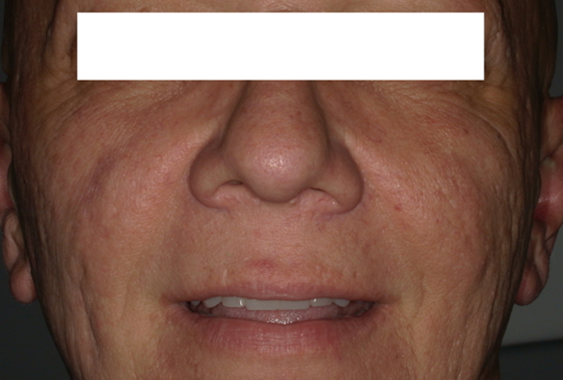 foto extra-orali a tre mesi dal secondo intervento