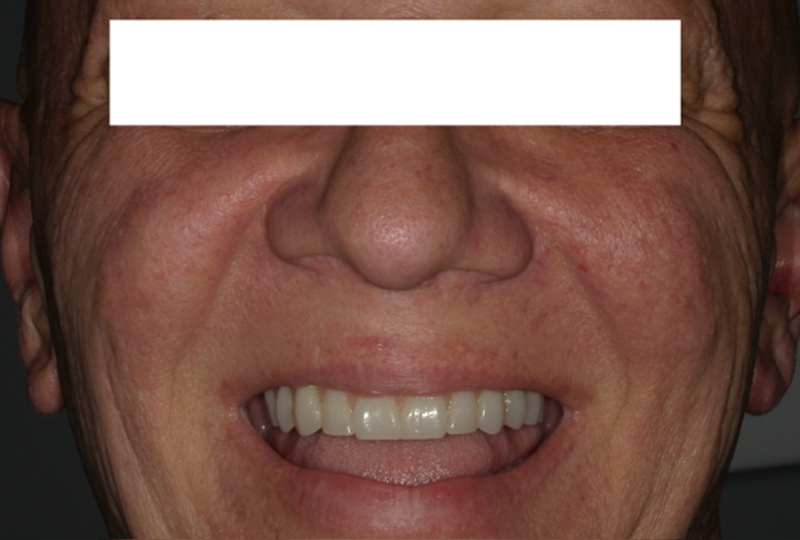 foto extra-orali a tre mesi dal secondo intervento