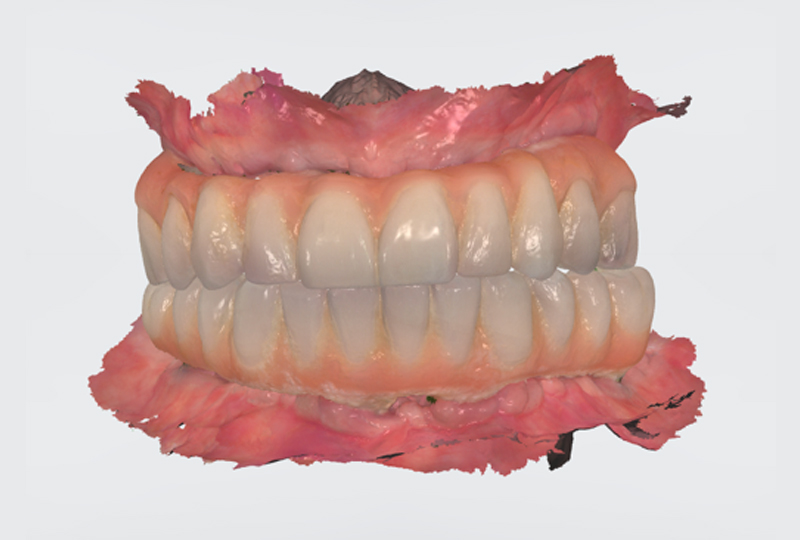 Scansione intraorale con protesi avvitata