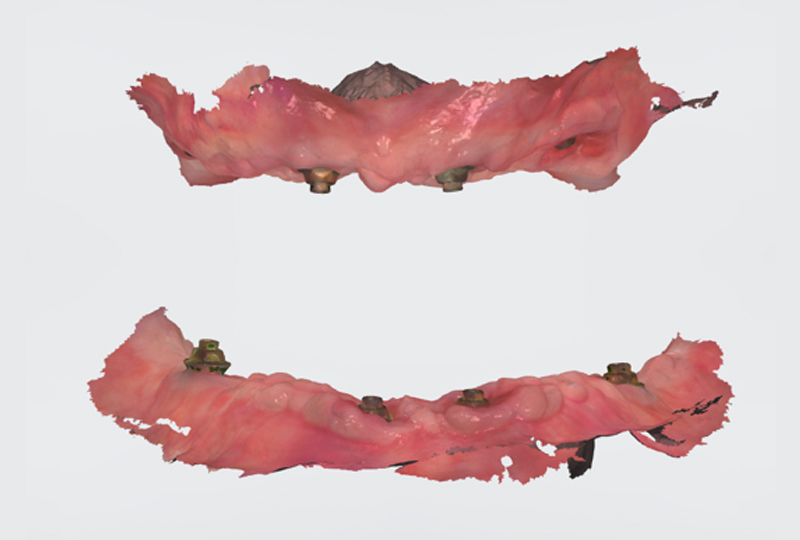 Scansione intraorale profilo gengivale 