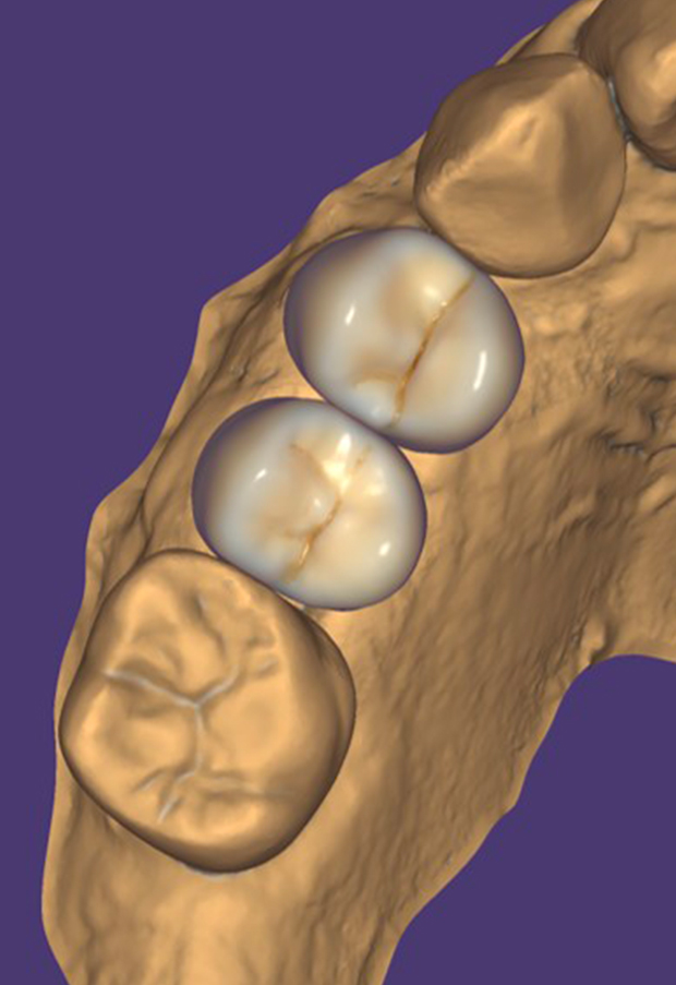 Rendering fotorealistico Truesmile di Exocad della modellazione del restauro