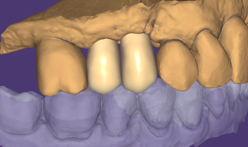 Rendering fotorealistico Truesmile di Exocad della modellazione del restauro, visione laterale