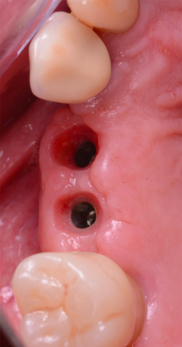 salute dei tessuti dopo rimozione degli scan healing abutments i-Physio