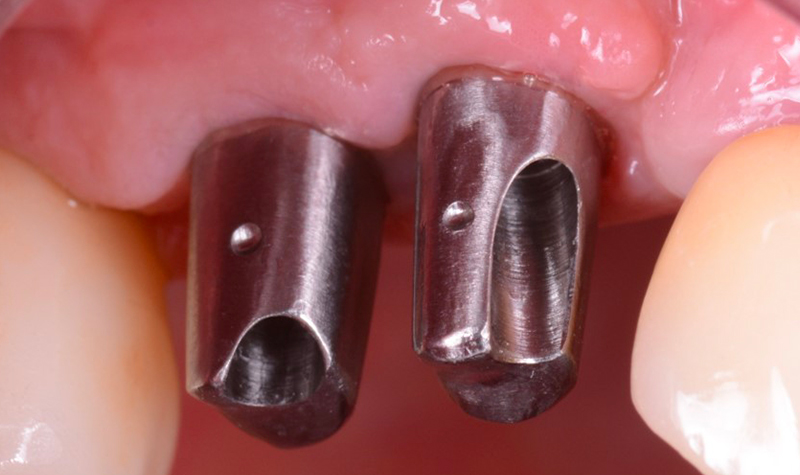 Inserimento dei monconi individuali fresati da Lyra Etk.