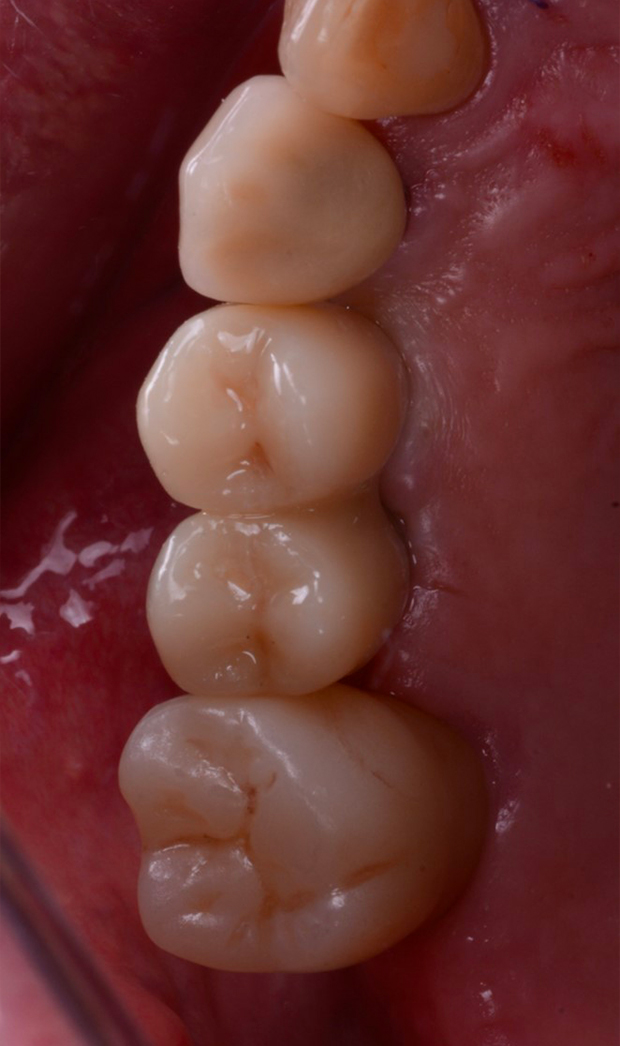 restauro stampato con tecnica tilted stereolithography