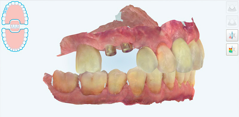 Scansione intraorale con iTERO Element 5D Plus, visione laterale