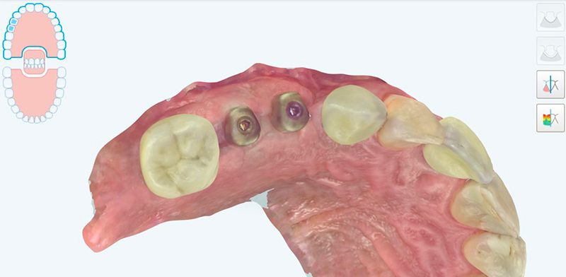 Scansione intraorale con iTERO Element 5D Plus, visione occlusale