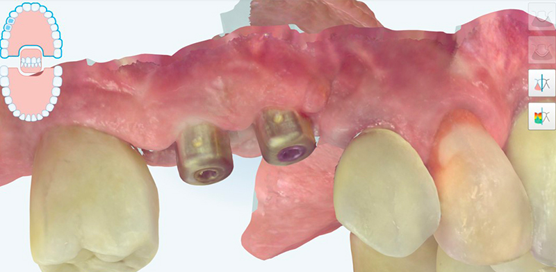 Dettaglio degli i-Physio catturati nella scansione intraorale del modello master