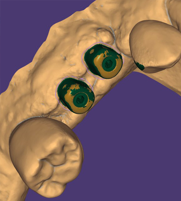 Dettaglio occlusale degli i-Physio nel software di CAD