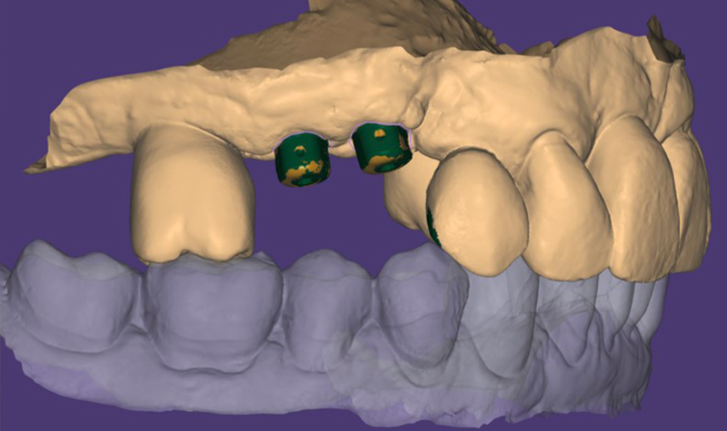 Gli i-Physio nel software di CAD visione laterale