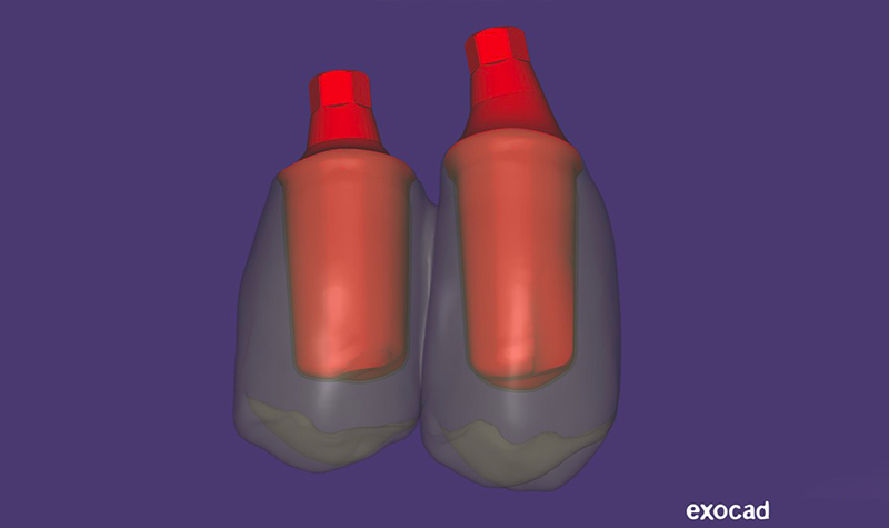 Dettaglio di modellazione CAD del ponte e dei monconi individuali