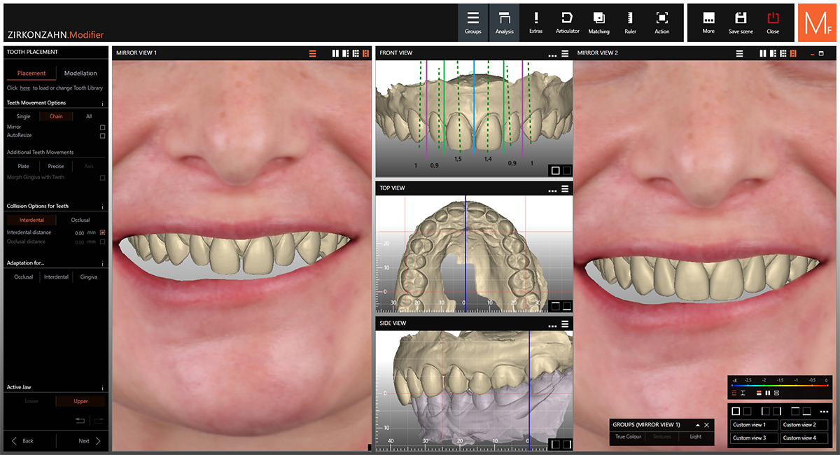 Progettazione e posizionamento digitale delle faccette
