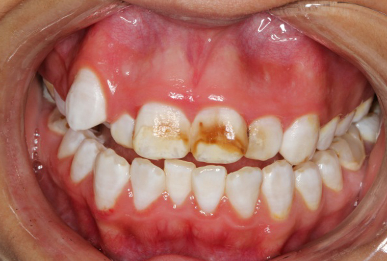 lesioni dello smalto