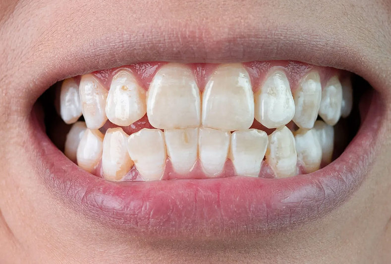 lesioni dello smalto