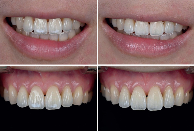 Casi clinici sull'applicazione della tecnologia QFL per il trattamento delle lesioni dello smalto