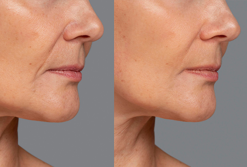 Prima e dopo biorivitalizzazione