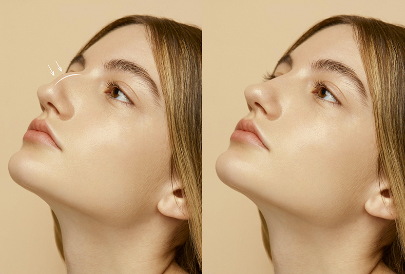 Ragazza prima e dopo il rinofiller