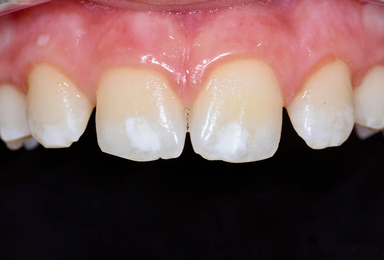 Discromie dentali tecniche di intervento