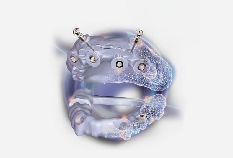 Exoplan: tecnologia e controllo al servizio dell'implantologia moderna