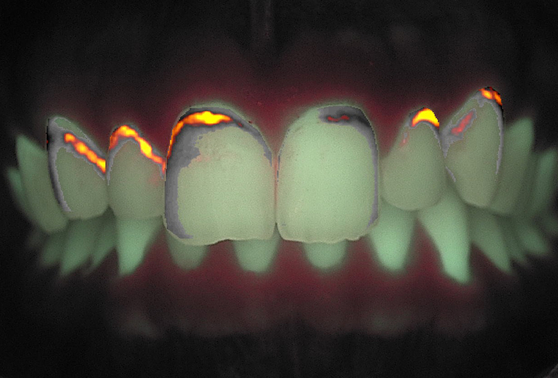 Infiltrazione resinosica per il trattamento non invasivo delle lesioni ipocalcifiche