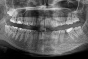 Allineatori e spazi edentuli: Mesializzazione dei molari