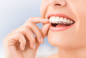 Mesializzazione dei molari con allineatori Sorridi senza Attachments