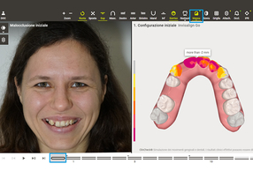 Invisalign Smile Architect