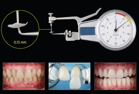 faccette in zirconia Prettau Skin