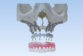 Impianti subperiostali iuxta-3D