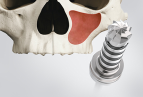 Rialto: kit per il rialzo del seno mascellare 