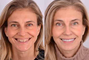 Prima e dopo Metodo Re-smiling