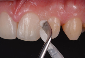 applicazione CURODONT™ REPAIR