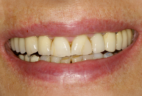 Riabilitazione del primo quadrante attraverso navigazione dinamica