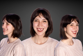 L'approccio digitale nella zona anteriore; gestione dei casi chirurgico-protesici