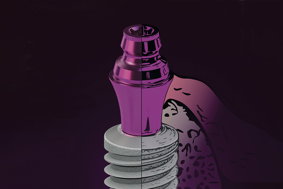 Condizioni Necessarie per il Successo del Protocollo "Bone Growth Concept" con Impianti SKY di Bredent