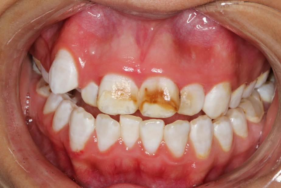 lesioni dello smalto