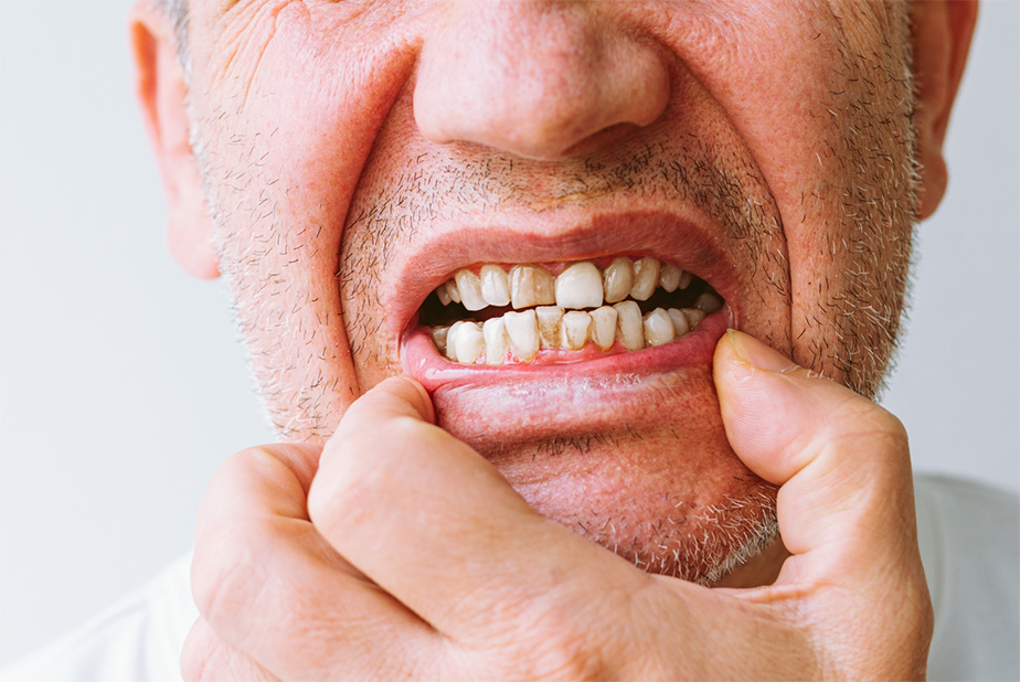 uomo mostra denti rovinati dal fumo