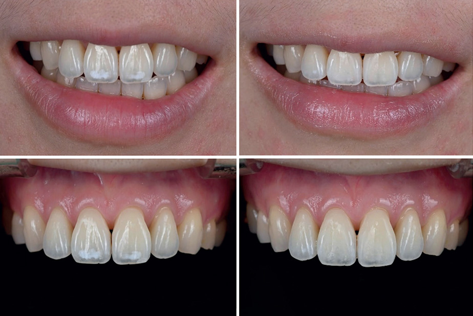 Casi clinici sull'applicazione della tecnologia QFL per il trattamento delle lesioni dello smalto