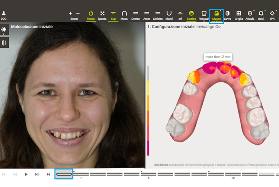 Invisalign Smile Architect