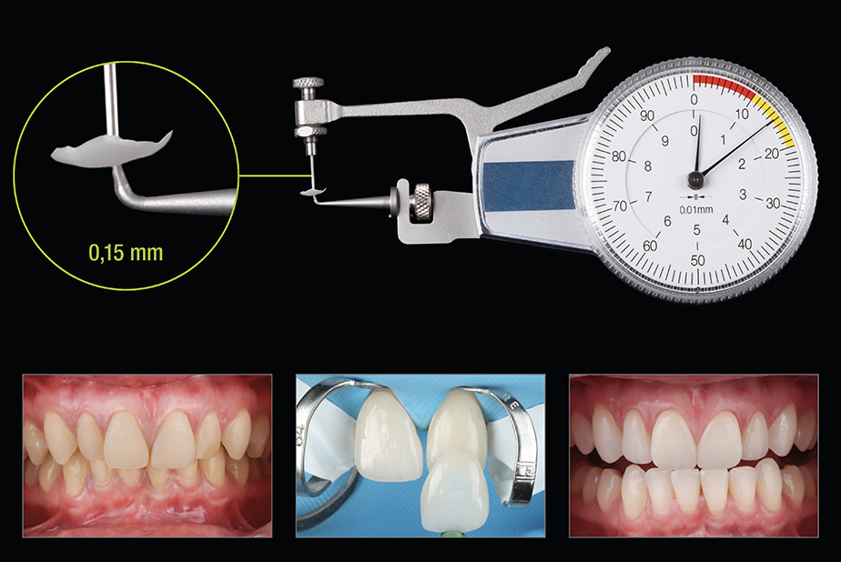 faccette in zirconia Prettau Skin