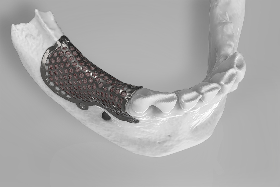 Mesh 3D personalizzata BTK