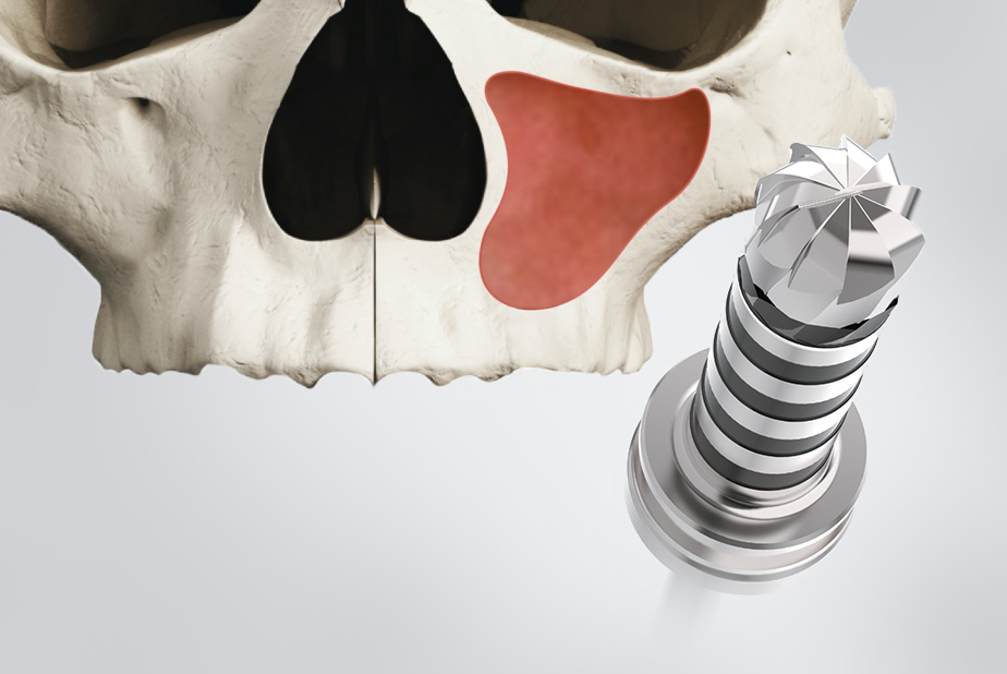 Rialto: kit per il rialzo del seno mascellare 