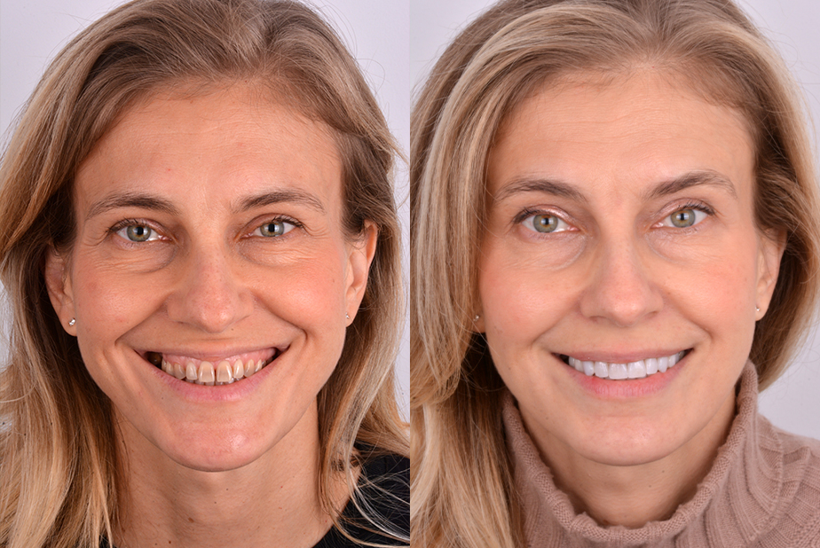 Prima e dopo Metodo Re-smiling