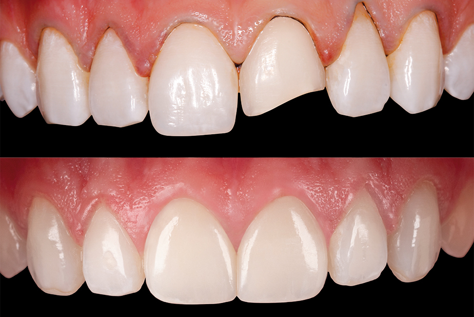 Prima e dopo l'utilizzo delle faccette Prettau Skin di Zirkonzahn