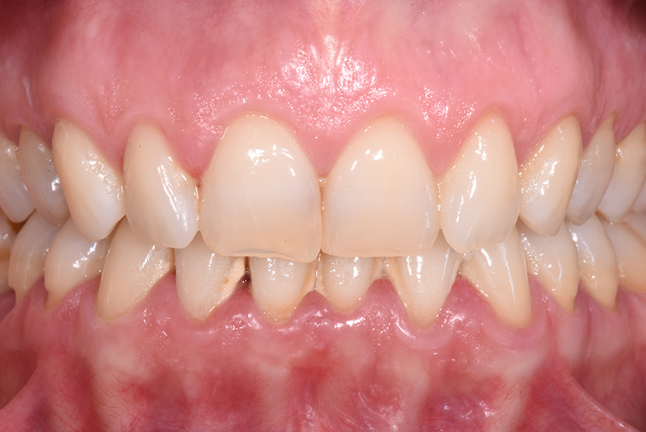 Efficacia di Olio ozonizzato